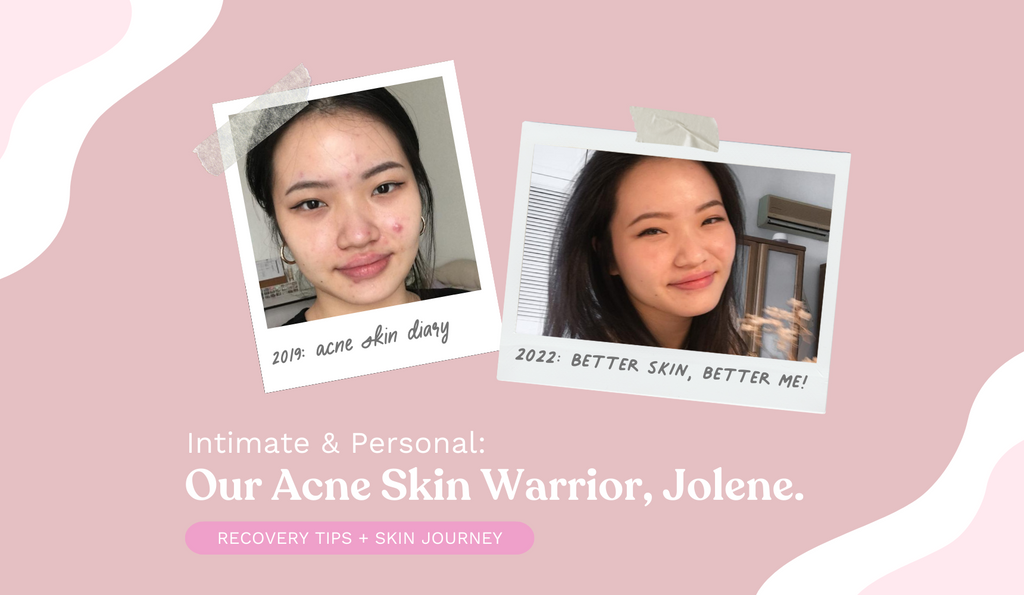 acne-skin-recovery